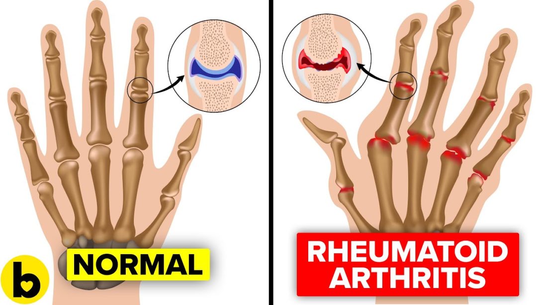 16 Early Warning Signs Of Rheumatoid Arthritis You Might Be Ignoring ...